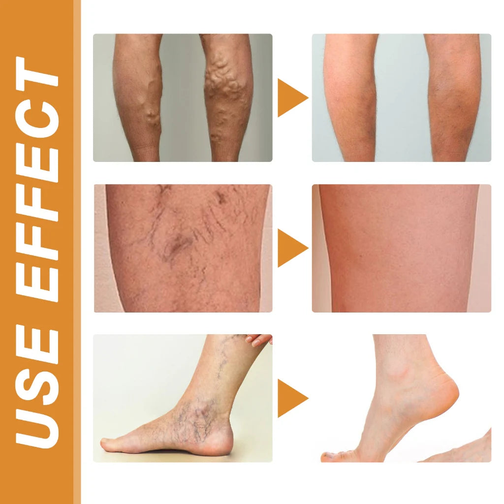 Vein Healing Varicose Veins Treatment Spray 50ml (Pack Of 2)