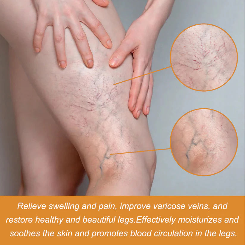 Vein Healing Varicose Veins Treatment Spray 50ml (Pack Of 2)